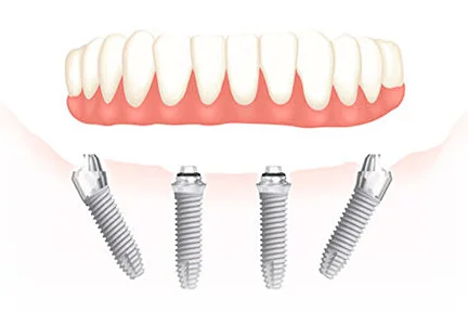 Dantură fixă All on 6 Premium